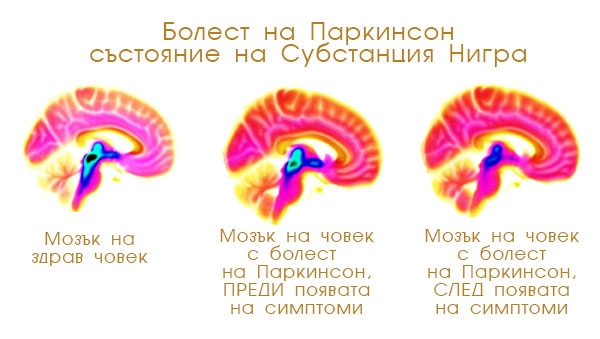 Промени в Субстанция Нигра при болест на Паркинсон