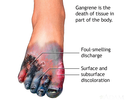 Гангрена – лечение, практически съвети, масаж