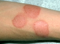 Алергичен  дерматит - лечение, специализирана помощ