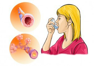 Лечение на астма