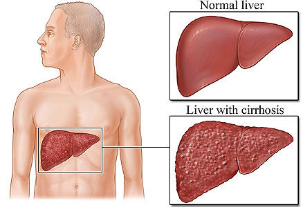 liver-cerose.jpg